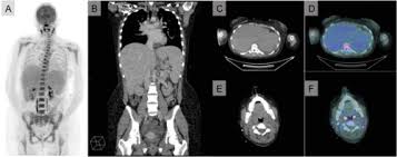 The disease occurs predominantly in persons. Epstein Barr Virus Associated Haemophagocytic Lymphohistiocytosis Treated With Anakinra And Rituximab A Case Report Sciencedirect