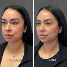 Albuquerque Full Face Balancing Before & After: Chrome Aesthetics