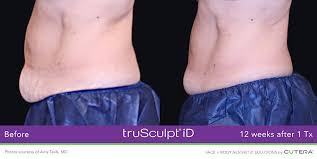 'an infection is one of the complications that can occur after having. Body Sculpting Ottawa Trusculpt Id Inovo Aesthetics