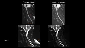 Spinal canal is preserved and there is no spinal . Magnetom Vida