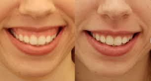 Fix a gummy smile with proven treatments and make it less noticeable. Gummy Smile Another Level Medispa