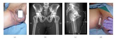 Maybe you would like to learn more about one of these? A 44 Year Old Male Presenting With Advanced Rh Of The Pelvis And Groin Download Scientific Diagram