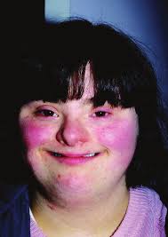 Thyroid Disorder in CYP with Down syndrome: Surveillance and when to  initiate treatment: April 2020 Information update: Down s