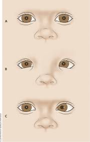 Widely separated eyes with epicanthal folds, broad nasal bridge, low set ears, and receding chin. Childhood Eye Examination American Family Physician