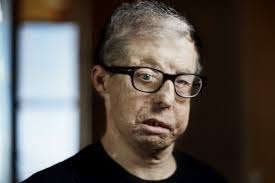 La face greffée de Jérôme Hamon