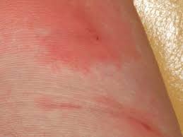 Intertrigo Causes Symptoms Pictures And Treatment