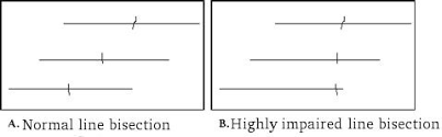 If you answered yes to both questions then you need to visit an eye doctor for an eye test as soon as possible. Line Bisection Test Strokengine