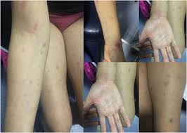 They can be spread from person to. Chronic Meningococcemia Sciencedirect