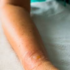 Necrotizing Fasciitis Avoid This Flesh Eating Disease Dr Axe Flesh Eating Bacteria Emergency Medical Dr Axe
