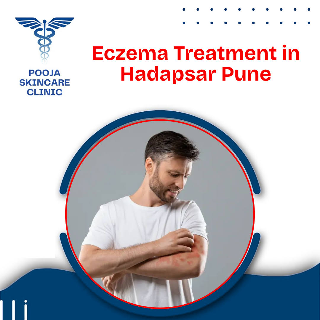 Eczema Treatment in Hadapsar Pune product image
