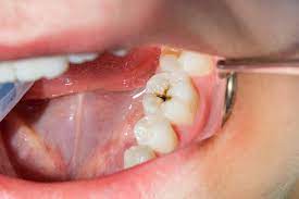 If a cavity grows large enough, it can reveal the next layer of the. What Happens If You Don T Treat A Cavity A Dentist Explains