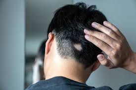 Image result for Alopecia
