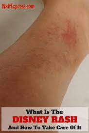 How to take care of a rash. What Is The Disney Rash And How To Take Care Of It