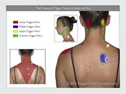 trapezius trigger points are like opinions everyone has one