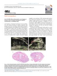 staging of prostate cancer is a necessary step to determine the extent of the disease and select the best treatment strategy. Pdf Use Of 29 Mhz Micro Ultrasound For Local Staging Of Prostate Cancer In Patients Scheduled For Radical Prostatectomy A Feasibility Study