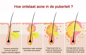 ACNE (JEUGDPUISTJES) | Wat kan ik er aan doen? | huidinfo.nl - uitleg van  de dermatoloog