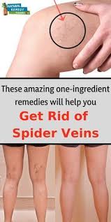 Pin By Stephanie Stokes On Diy Projects In 2020 Get Rid Of Spider Veins Spider Veins Spider Vein Remedies