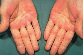 The primary form of palmar erythema is attributed to heredity but it can also appear in women who are pregnant or as an idiopathic form (of unknown cause). Palmar Erythema Causes Diagnosis Palmar Erythema Treatment
