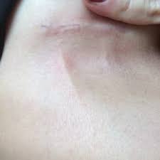 Mondor's disease is a rare condition wherein an inflammation of veins occurs in different parts of the body. Should I Be Worried About Mondor Disease Photo