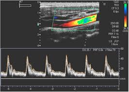 Progress Of Doppler Ultrasound System Design And