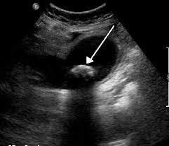 Biliary Colic Wikipedia