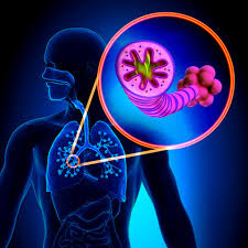 Asthma is the disease most often confused with chronic obstructive pulmonary disease. Copd Diagnosis What Can You Learn From Screening And Testing University Health News