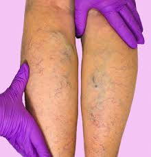 Vulvar varicosities occurs most often in pregnant women, but has been known to occur in women who are not pregnant as well. Varicose Veins Surgery Varicose Vein Treatment Specialist Boca Raton