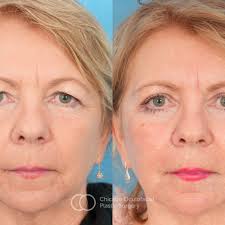 TOP 10 BEST Eye Bag Removal in Chicago, IL