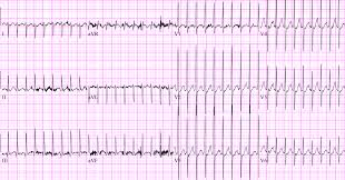 This page is about the various possible meanings of the acronym, abbreviation, shorthand or slang term: Pediatric Svt Em Sim Cases