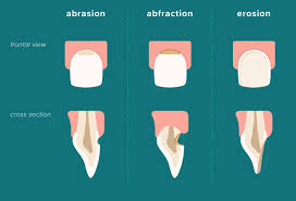 Image result for Tooth Abrasion