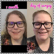 Bariatric surgery weight loss progress and support