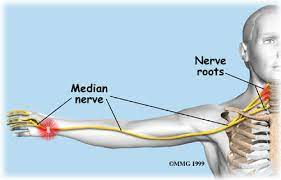 Carpal Tunnel Syndrome Vs Cervical Radiculopathy Three Rivers Orthopedics