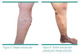 Varicose Veins Nuhcs National University Heart Centre Singapore