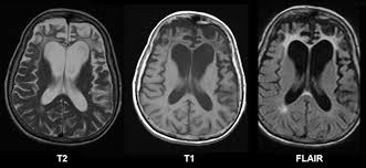 Lewy body dementia, also known as dementia with lewy bodies, is the second most common type of progressive dementia after alzheimer's disease dementia. Frontotemporal Dementia Wikipedia