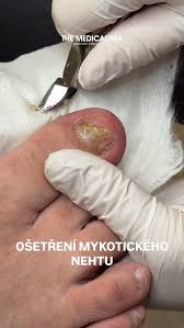 Image result for mykoza nehtů