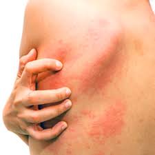 La dermatite allergica alimentare è causata dalla reazione allergica ad alcuni cibi: Orticaria Di Cosa Si Tratta Cause E Terapie Issalute