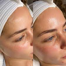 Hydrafacial Dermaplane Duo Laser Facial Dermaplaning Facial Before And After