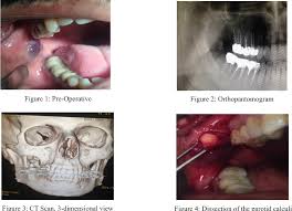 Image result for Sialolithiasis