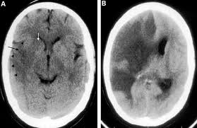 Many symptoms that might make you suspect your cat had a stroke are very similar to the even though these scans can be a bit expensive, this is the best way to pinpoint a condition such as. Radiology Of Stroke Journal Of Neurology Neurosurgery Psychiatry