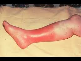 Home Remedies For Cellulitis Home Remedies For Skin Cellulitis Infection Cellulitis Remedies