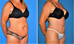 How long does recovery take? Abdominoplasty Surgery Recovery Before And After Risks