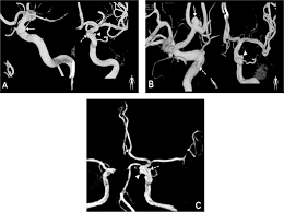 Image result for Progressive Bulbar Paralysis