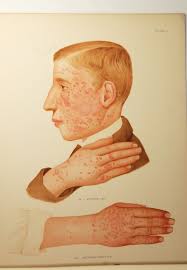 Atlas of the Diseases of the Skin