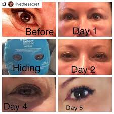 We LOVE that this fabulous patient chronicled her experience with our PRF  Under Eye Treatment. These are her pictures and words...thanks for sharing,  @livethesecret ❤️ . . . . . . . “