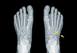 These problems can result in limited movement and mobility. Kids Outer Foot Pain My Footdr