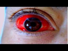 Ojo Rojo Ojo Rojo Proceso De Curacion Tratamiento Ojo Rojo Youtube
