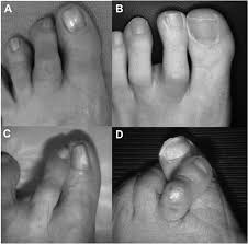 Progression Of Crossover Second Toe Deformity Beginning As Mild Download Scientific Diagram progression of crossover second toe