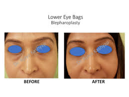 Eyelid Surgery In India Eyelid Surgery Eyelid Lift Surgery