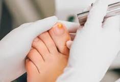 Image result for how much does laser treatment for nail fungus cost