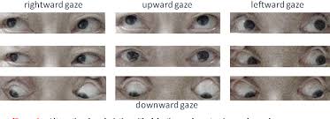 Image result for Eye Deviation